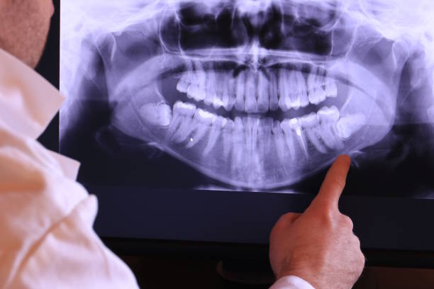 Best Emergency Wisdom Teeth Removal in Syracuse, UT
